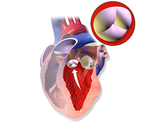 Transcatheter Aortic Value Replacement Beneficial for Aortic Stenosis, Study Concludes