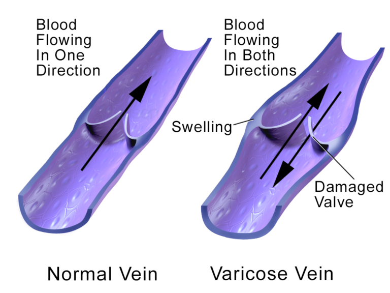 What are the Common Problems of Veins?