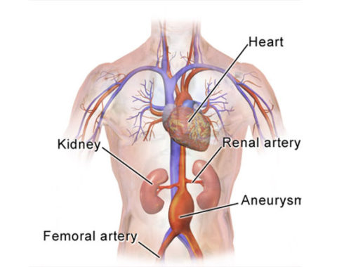 What is an Abdominal Aortic Aneurysm?