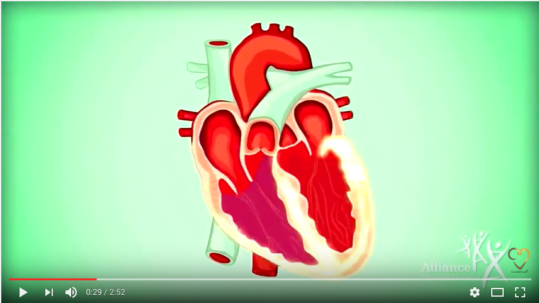Snippet Video from CardioVisual — Atrial fibrillation