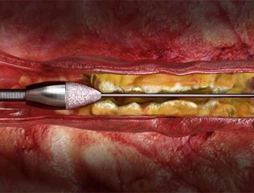 Rotational Atherectomy for Peripheral Artery Disease