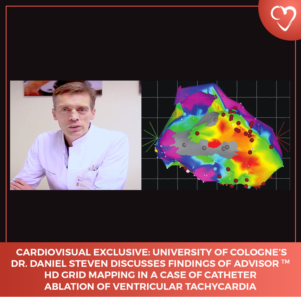 University of Cologne’s Dr. Daniel Steven discusses findings of HD Mapping in a case of catheter ablation of ventricular tachycardia