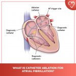 What is Catheter Ablation for Atrial Fibrillation? - CardioVisual ...